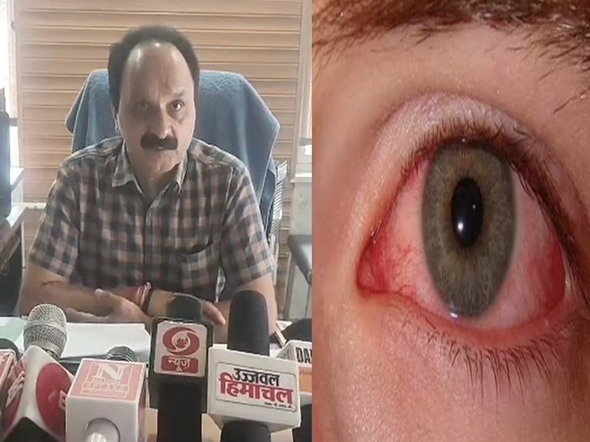 आई फ्लू के मामले