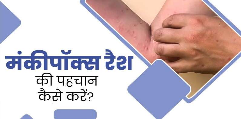 हिमाचल में मंकी पॉक्स के संदिग्धों के सैंपलों की IGMC